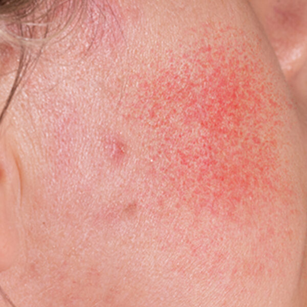 03-What is Chronic Redness, or Rosacea