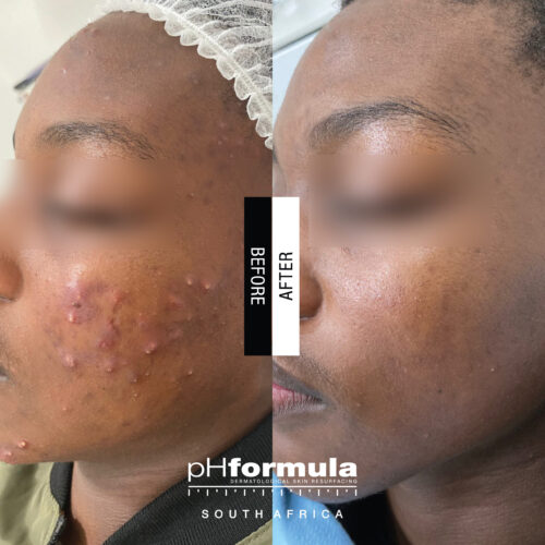 Case Study - Acne resurfacing treatments 3A - 1
