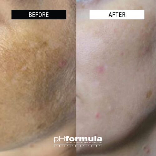 Case Study - Powerful hyper-pigmentation treatment - 2