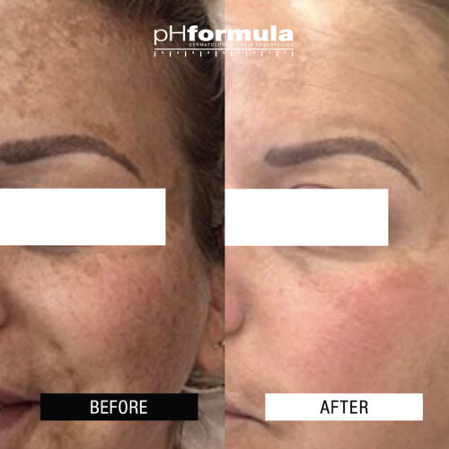 Case Study - Powerful hyper-pigmentation treatment - 3